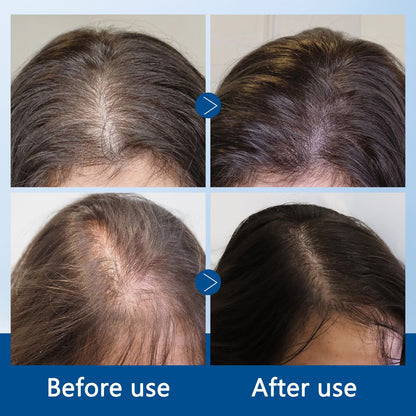 Hair Growth Roll-On Serum – Rosemary 3% | Aminexil 2% | Redensyl 3% | Anagain 2% | Fuller Hair in 4 Weeks